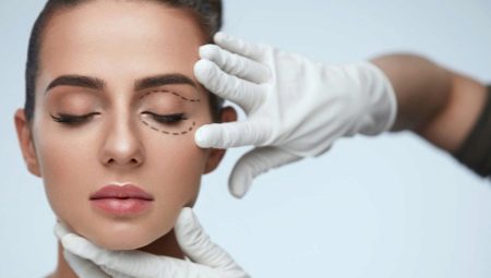 Blepharoplasty: features and technique