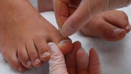 Toenails grow up: causes and methods of treatment